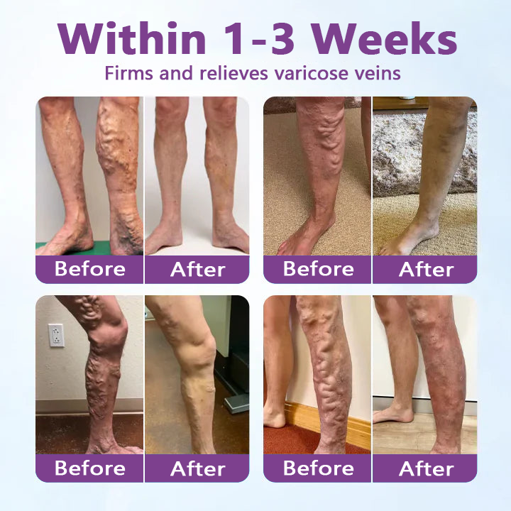 Varicose Vein Treatment Cream